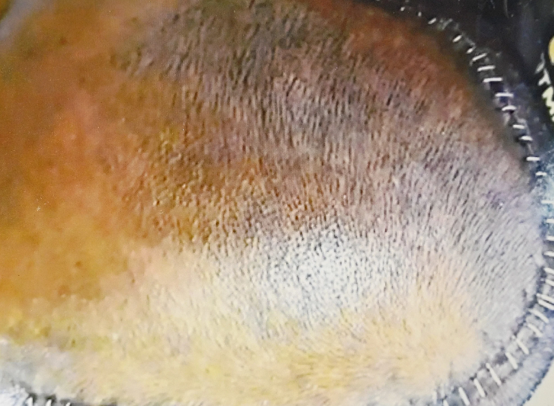 Man with blood clot in brain 'the size of a golf ball' odds